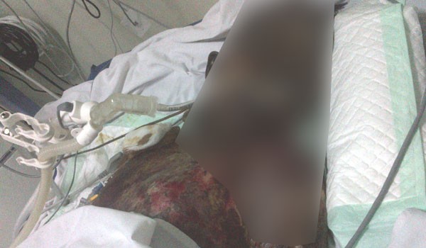 Korban luka bakar Fadhilah Hafis Pratama yang dirawat di rumah sakit Raden Mattaher Jambi