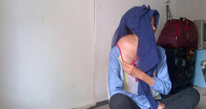 Nasib Herlia, penderita Tumor ganas di leher kiiri.