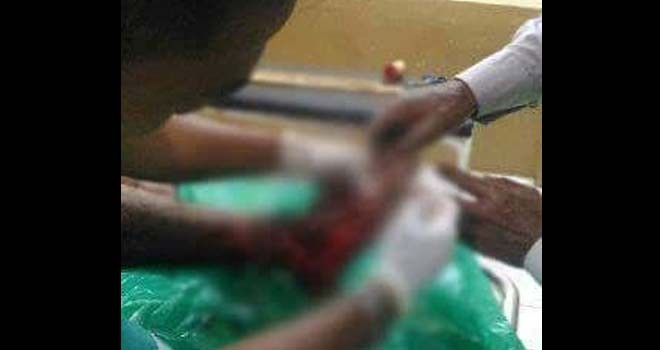 Kaki korban luka parah akibat tertimpa pohon di Gunung Kerinci.