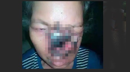 Nenek Penderita Kanker Ganas Selama 12 Tahun Tak Punya Biaya Berharap Bantuan Gubernur dan Bupati.