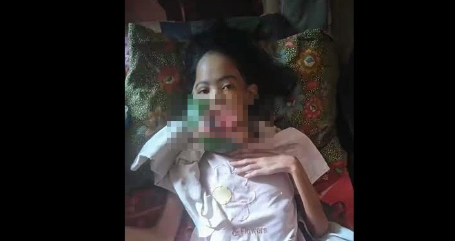 Neti, warga Desa Teluk Kijing Kecamatan Nipah Panjang yang mengalami sakit di mulutnya.