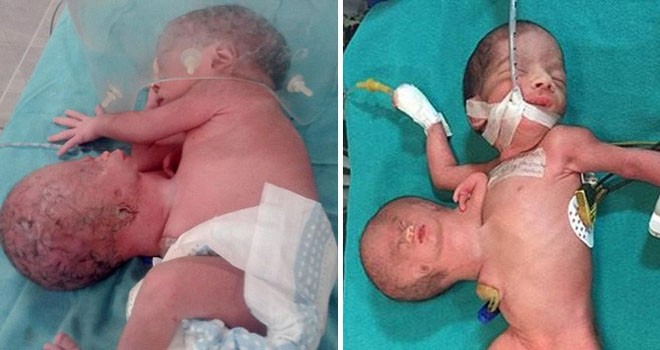 KEMBAR PARASIT: Bayi dengan kepala dan tangan tambahan. (Carters News Agency, Rare Shoots News via Daily Mail)