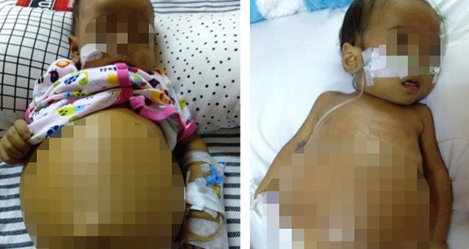 M Syahreza Andina, bayi 8 bulan dirawat di Rumah Sakit Cipto Mangunkusumo (RSCM) Jakarta yang mengidap penyakit Pembengkakan hati.