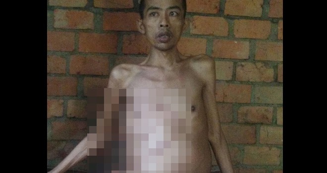  Penderita Tumor Ganas di Tebo yang Terpaksa Berobat Kampung.