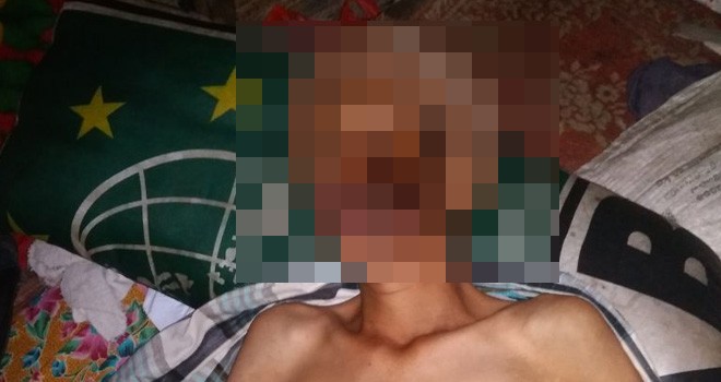 Suhaimi (45) Penderita Tumor di Pipi Asal Sungai Penuh.