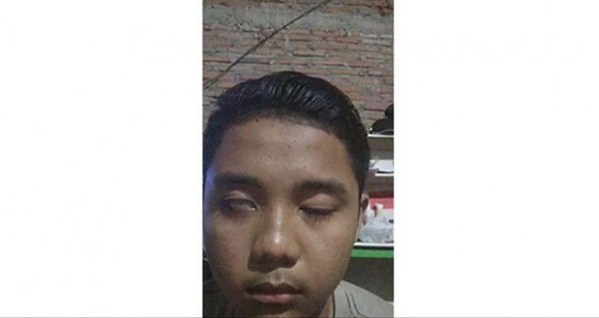 Kondisi mata Eko Wahyu Saputro yang tidak bisa terpejam. Foto : Radar Solo