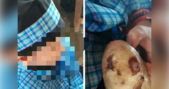 Muhammad Firli Elsyaqiri bocah 6 tahun, warga Kelurahan Teluk Dawan, Kecamatan Muara Sabak Barat, Kabupaten Tanjung Jabung Timur (Tanjabtim), sejak 4 tahun silam menderita penyakit kulit yang tidak dikenali alias langka.