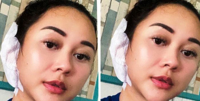 Aura Kasih dengan telinga yang diperban usai menjalani operasi.